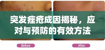 突发痤疮成因揭秘，应对与预防的有效方法