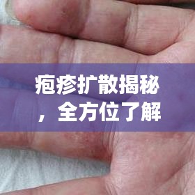疱疹扩散揭秘，全方位了解、预防与治疗指南