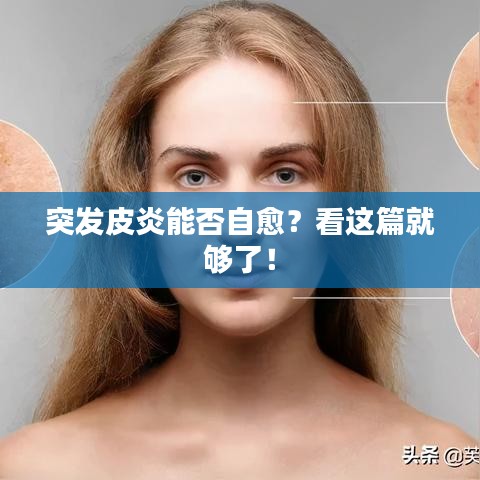 突发皮炎能否自愈？看这篇就够了！